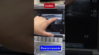  อาการปวดบวมข้อมือและก้อนนูนที่เกิดขึ้น มีสาเหตุมาจากอะไร 