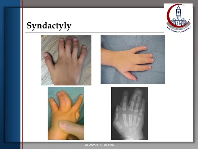 Hand lecture (Congenital hand anomalies and Trauma)