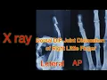 Reduction Technique for Finger Dislocation