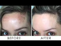 Download Lagu How I Got Rid Of Pigmentation / Melasma | Shonagh Scott