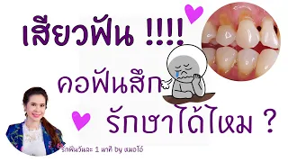 การรักษาอาการเสี่ยวฟันที่เกิดจากคอฟันสึก ทำอย่างไร