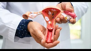¿Qué produce la endometriosis y cómo se trata? Ginecólogo revela datos del padecimiento