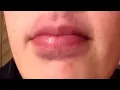 how to get rid of bruises on your lips fast