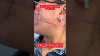 ازالة الندبات بالليزر فركشينال ليزر CO2 