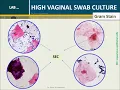 High Vaginal Swab HVS culture