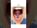 Jawbone Growths Mandibular Tori fauquierent