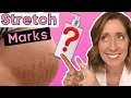 How to Fade Stretch Marks Proven Tips for Stretch Mark Treatments