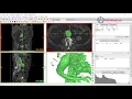 How to Segment a AAA for 3d Printing with Materialise Mimics