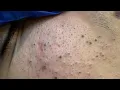 ASMR Deep Cleansing Techniques for Clear Skin and Blackheads Removal