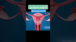    طريقه تركيب لولب هرموني        دندنها
