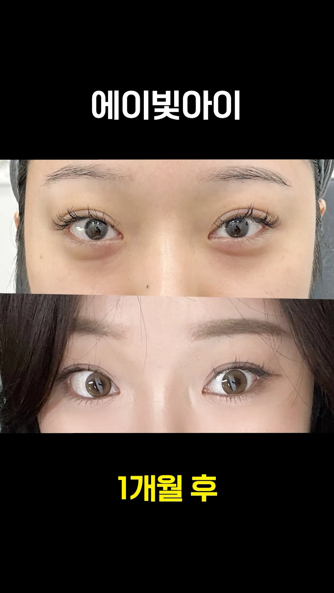 에이빛아이로 다크서클 순삭 ✔️