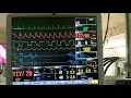 Adenosine induced transient cardiac arrest