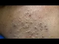 Advanced Blackhead Removal Techniques Deep Cleansing for Clear Skin