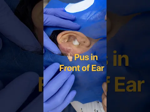Pus Collection in Front of Ear | Incision & Drainage of Abscess | ENT Treatment