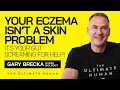 Why Your Eczema Isn t Just Skin Deep Here s the REAL Cause TUH