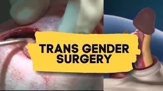 trans gender surgery male to female education