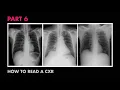 CXR Bones Soft Tissue - How to Read a Chest X-Ray Part 6