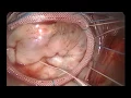 Download Lagu Minimal Invasive MV Repair with Loop Technique