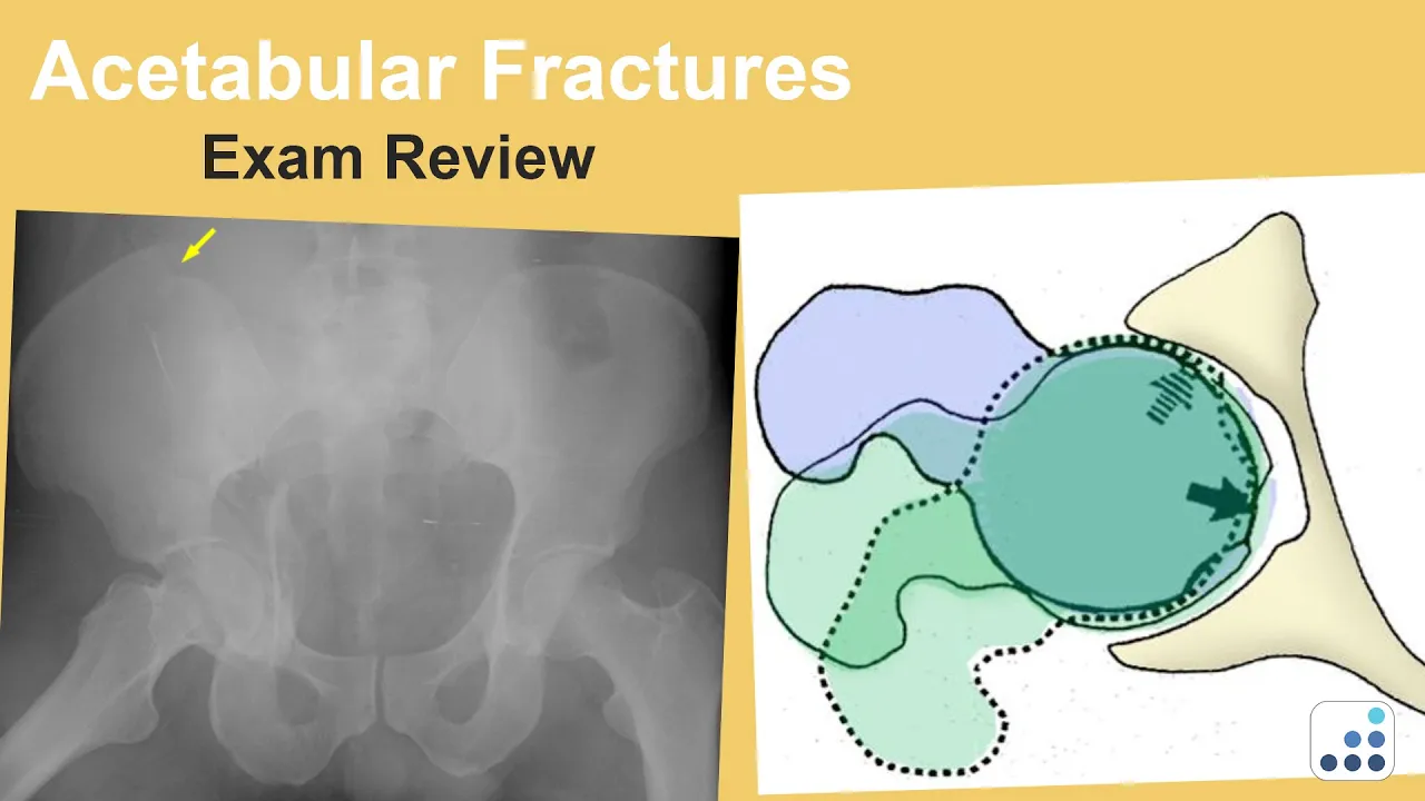 Proximal Third Tibia Fractures  Exam Review - Jan Szatkowski, MD. 