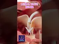 Download Lagu Transcatheter Mitral Valve Repair (TMVR) – Minimally Invasive Treatment for Mitral Regurgitation