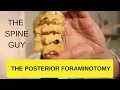 CERVICAL FORAMINAL STENOSIS RADICULOPATHY - PART 4