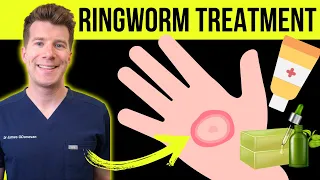 doctor explains how to treat ringworm jock itch athletes foot medications plus natural remedies
