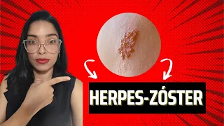 Você teve catapora? Então precisa assistir a esse vídeo!
