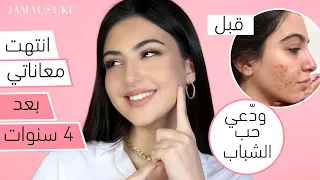 كيف تخل صت من حب الشباب إليك الحل 