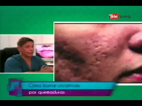 Cómo borrar cicatrices por quemaduras