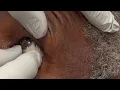 Download Lagu Prosthetic Eye Insertion