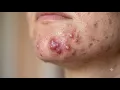 Loan Nguyen Acne Treatment 30zz