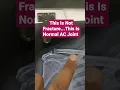 This Is Not Fracture This Is Normal AC Joint Dr Sai Chandra MBBS DNB Ortho