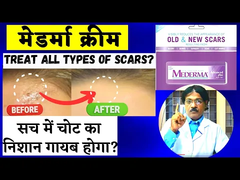 Download MP3 Mederma cream | Mederma advanced scar gel true review in hindi | Scars & स्ट्रेच मार्क्स का ईलाज