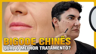 BIGODE CHINÊS | Qual o melhor tratamento?