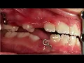 Class III C - Maxillary Expansion Bollards and Myofunctional Therapy