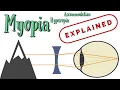 Refractive errors of the eye