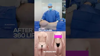 Achieve Your Dream Body With 360 Liposuction And Brazilian Butt Lift Transformation