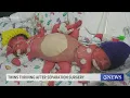 Twins thriving 5 years after separation surgery at Driscoll Children s Hospital
