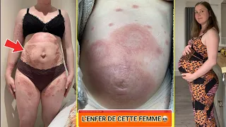 Allergique à son propre bébé dans son ventre, elle vit un calvaire médical hors du commun.