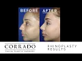 Rhinoplasty Cast Removal Revealing Her New Nose Dr Anthony Corrado