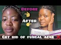 How I Cleared My Fungal Acne in 7 Days Malassezia Safe Routine