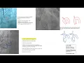 Download Lagu Left+right coronary engagement for general fellows: step-by-step tips, diagrams, caveats (5 for RCA)