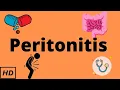 Peritonitis Causes Signs and Symptoms Diagnosis and Treatment