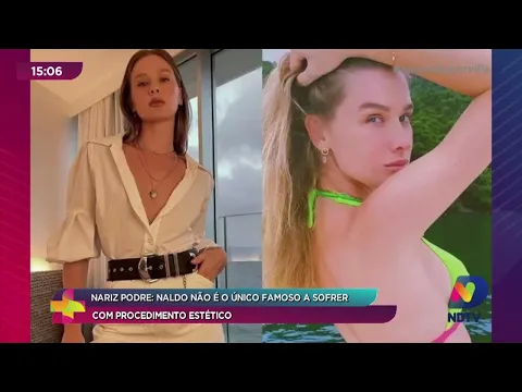 Nariz podre: Naldo não é o único famoso a sofrer com procedimento estético