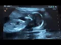 16 weeks pregnancy Ultrasound