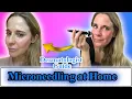 How to do Microneedling at Home Dermatologist Guide