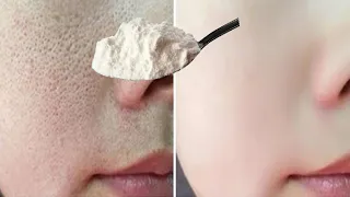 المسامات المفتوحة ستختفي وتتقلص للأبد في 3 ايام/ تفتيح البشرة 10 درجات بياض ملفت