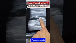  อาการเจ็บที่หน้าขาของนักกีฬาฟุตบอลเกิดจากอะไร 