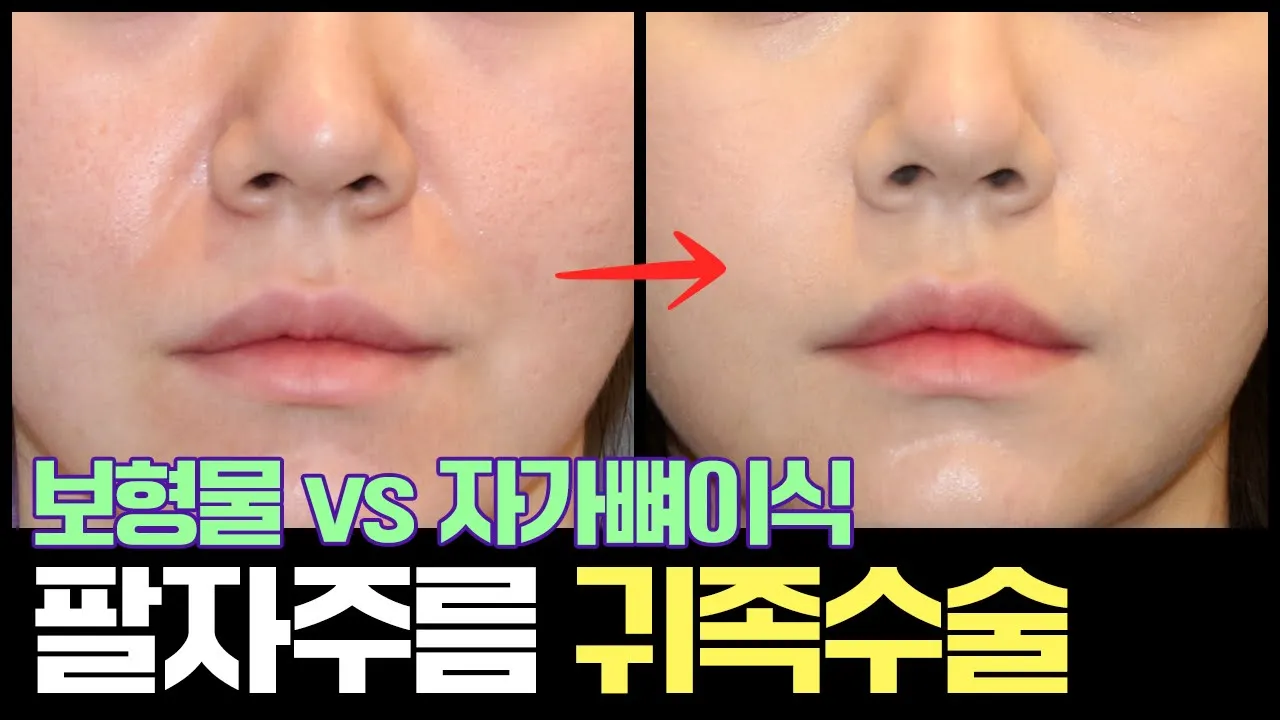 귀족보형물 vs 자가뼈이식 귀족수술 총정리│부작용 및 추천 대상