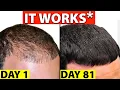 Download Lagu The Truth About Finasteride (Propecia) for Hair Loss